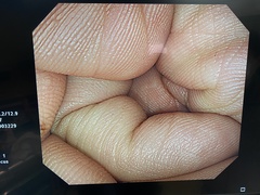 大腸ビデオスコープ｜CF-H260AI｜オリンパスメディカルシステムズ株式会社の写真6枚目