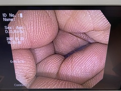 大腸ビデオスコープ｜PCF-Q150AI｜オリンパスメディカルシステムズ株式会社の写真6枚目