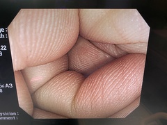 大腸ビデオスコープ｜CF-H260AZI｜オリンパスメディカルシステムズ株式会社の写真6枚目