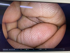 上部消化管用経鼻スコープ｜EG-530NW｜富士フイルムメディカルの写真6枚目