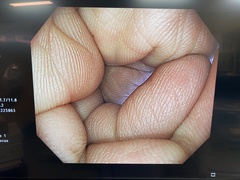 Video Colonoscope｜PCF-H290ZI｜Olympus Medical Systems photo6