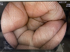 下部消化管用拡大スコープ｜EC-L600ZP7｜富士フイルムメディカルの写真6枚目