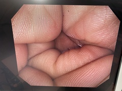 大腸ビデオスコープ｜PCF-Q260AI｜オリンパスメディカルシステムズ株式会社の写真6枚目