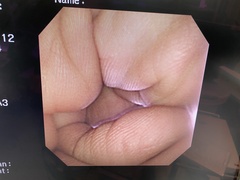 Video Transnasal Gastroscope｜GIF-N260｜Olympus Medical Systems photo6