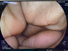 Video Colonoscope｜EC-L600ZP7｜Fujifilm Medical photo6