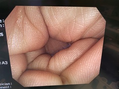 大腸ビデオスコープ｜CF-Q260AI｜オリンパスメディカルシステムズ株式会社の写真6枚目