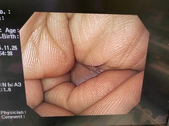 上部消化管汎用ビデオスコープ｜GIF-PQ260｜オリンパスメディカルシステムズ株式会社の写真6枚目