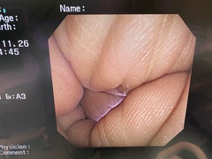 上部消化管汎用ビデオスコープ(径鼻対応)｜GIF-XP260N｜オリンパスメディカルシステムズ株式会社の写真6枚目