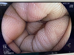 下部消化管用拡大スコープ｜EC-L600ZP｜富士フイルムメディカルの写真6枚目