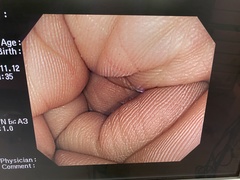 Video Colonoscope｜PCF-Q240ZI｜Olympus Medical Systems photo6