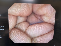 大腸ビデオスコープ｜CF-Q260AI｜オリンパスメディカルシステムズ株式会社の写真6枚目