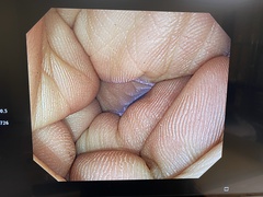 大腸ビデオスコープ｜PCF-H290TI｜オリンパスメディカルシステムズ株式会社の写真6枚目