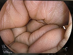 Video Colonoscope｜EC-L600MP7｜Fujifilm Medical photo6