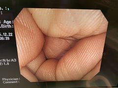 Video Colonoscope｜CF-H260AZI｜Olympus Medical Systems photo6