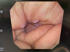 上部消化管汎用ビデオスコープ｜GIF-XQ240｜オリンパスメディカルシステムズ株式会社の写真6枚目