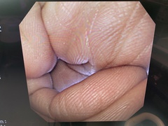 上部消化管汎用ビデオスコープ｜GIF-XQ240｜オリンパスメディカルシステムズ株式会社の写真6枚目