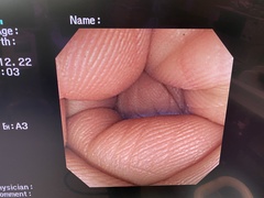 Video Colonoscope｜CF-240I｜Olympus Medical Systems photo6