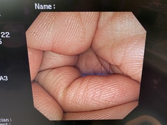 Video Colonoscope｜CF-240I｜Olympus Medical Systems photo6