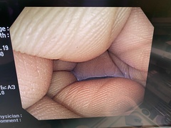 Video Colonoscope｜PCF-Q260AI｜Olympus Medical Systems photo6