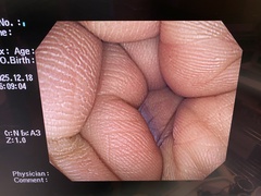 Video Colonoscope｜PCF-Q260AL｜Olympus Medical Systems photo6