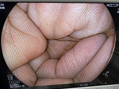 Video Colonoscope｜EC-L600ZP7｜Fujifilm Medical photo6