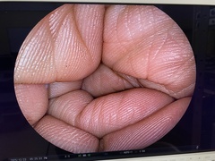 下部消化管用細径スコープ｜EC-590MP｜富士フイルムメディカルの写真6枚目