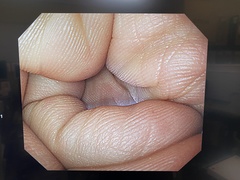 上部消化管汎用ビデオスコープ｜GIF-PQ260｜オリンパスメディカルシステムズ株式会社の写真6枚目