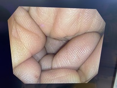 Video Colonoscope｜PCF-Q150AI｜Olympus Medical Systems photo6