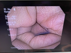 Video Colonoscope｜PCF-Q150AI｜Olympus Medical Systems photo6