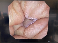 Video Transnasal Gastroscope｜GIF-XP260N｜Olympus Medical Systems photo6