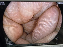 Video Colonoscope｜EC-L600ZP7｜Fujifilm Medical photo6