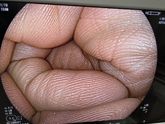 Video Colonoscope｜EC-L600ZP7｜Fujifilm Medical photo6