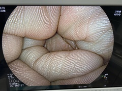 Video Colonoscope｜EC-L600MP7｜Fujifilm Medical photo6