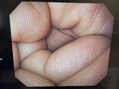 上部消化管汎用ビデオスコープ｜GIF-H260｜オリンパスメディカルシステムズ株式会社の写真6枚目