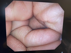 Video Colonoscope｜CF-Q260AI｜Olympus Medical Systems photo6