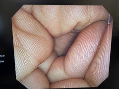 Video Colonoscope｜CF-H260AI｜Olympus Medical Systems photo6