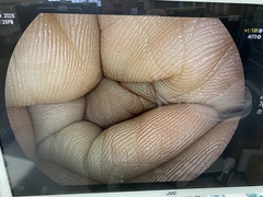 上部消化管用スコープ｜EG-760R｜富士フイルムメディカルの写真6枚目