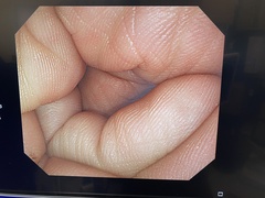 大腸ビデオスコープ｜PCF-Q260AI｜オリンパスメディカルシステムズ株式会社の写真6枚目