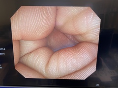 大腸ビデオスコープ｜PCF-Q260AI｜オリンパスメディカルシステムズ株式会社の写真6枚目