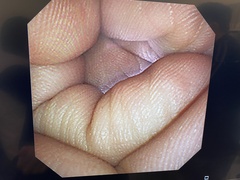 上部消化管汎用ビデオスコープ(径鼻対応)｜GIF-XP260N｜オリンパスメディカルシステムズ株式会社の写真6枚目