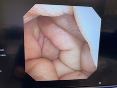 気管支ビデオスコープ｜BF-260｜オリンパスメディカルシステムズ株式会社の写真6枚目