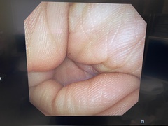 Video Bronchoscope｜BF-260｜Olympus Medical Systems photo6