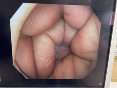 大腸ビデオスコープ｜CF-H290I｜オリンパスメディカルシステムズ株式会社の写真6枚目