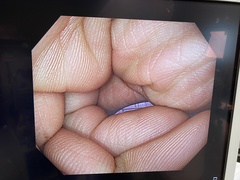 大腸ビデオスコープ｜PCF-H290I｜オリンパスメディカルシステムズ株式会社の写真6枚目