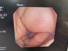 Video Colonoscope｜PCF-240I｜Olympus Medical Systems photo6