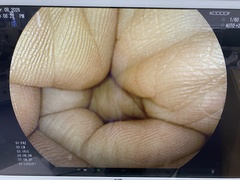 下部消化管用拡大スコープ｜EC-L600ZP7｜富士フイルムメディカルの写真6枚目