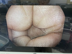 Video Gastroscope｜EG16-K10｜Pentax photo6