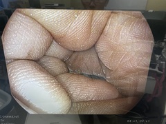 Video Gastroscope｜EG16-K10｜Pentax photo6