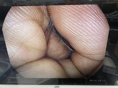 Video Colonoscope｜EC38-i10M｜Pentax photo6