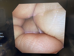 Video Transnasal Gastroscope｜GIF-XP260N｜Olympus Medical Systems photo6